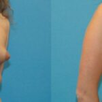 Breast Implant #30 - Before and After