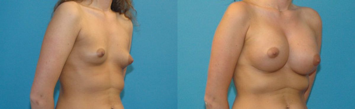 Breast Implant #30 - Before and After