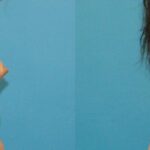 Breast Implant #30 - Before and After