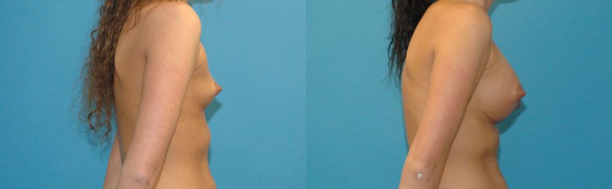 Breast Implant #30 - Before and After