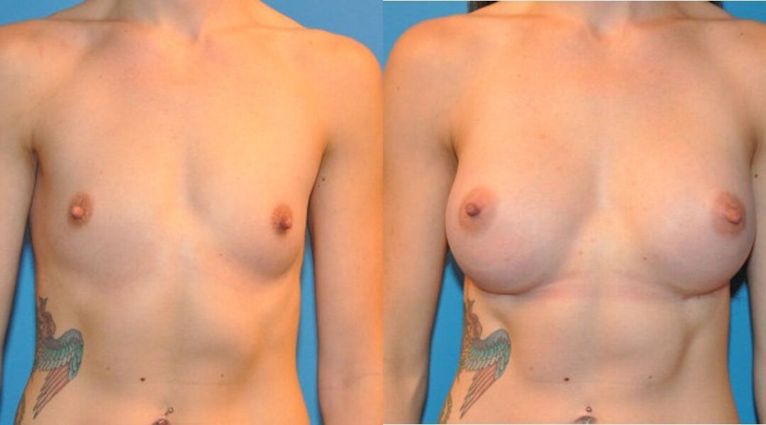 Breast Implant #31