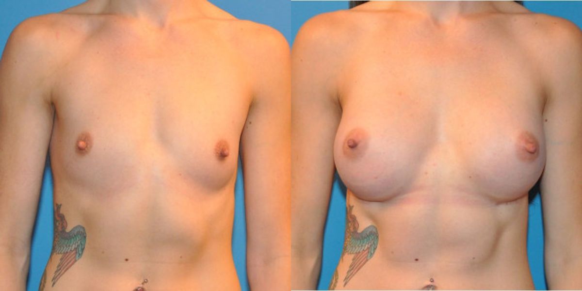 Breast Implant #31 - Before and After