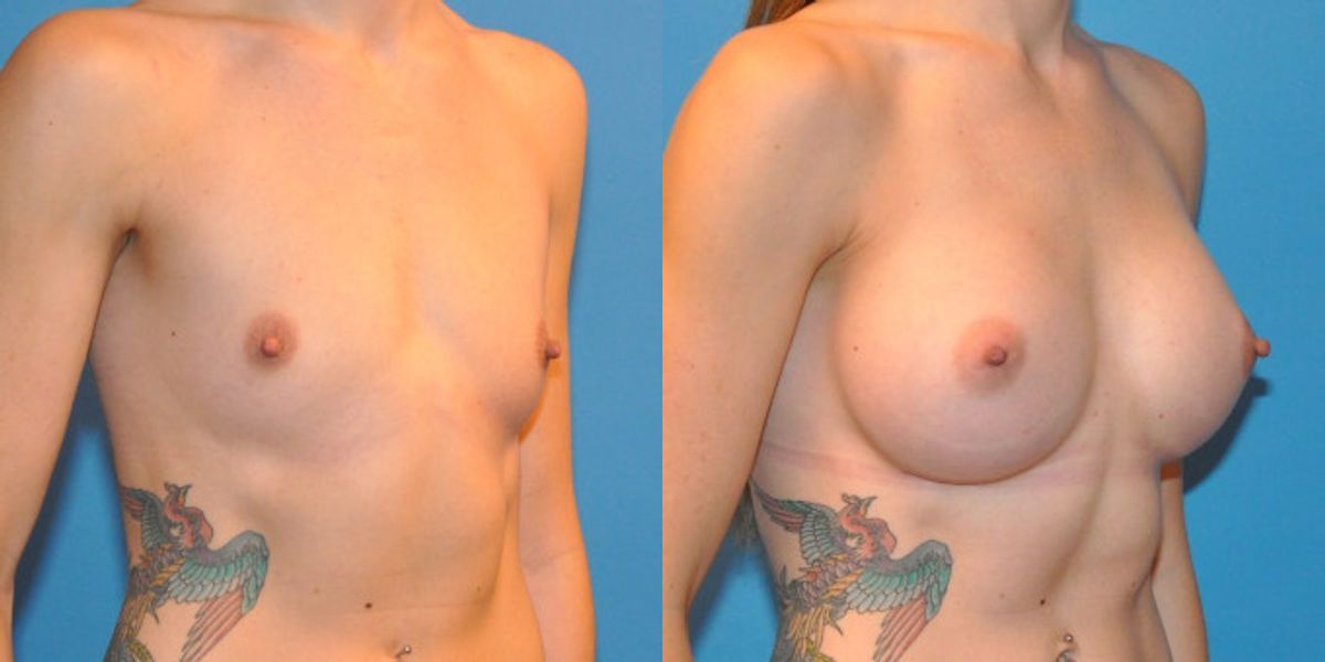 Breast Implant #31 - Before and After