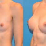 Breast Implant #31 - Before and After