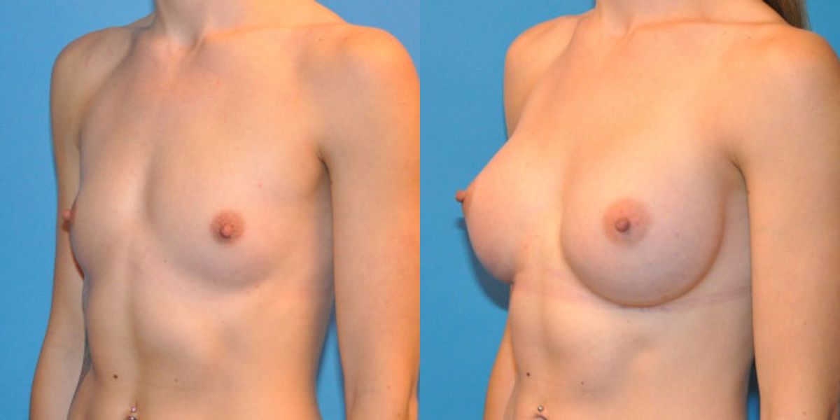 Breast Implant #31 - Before and After