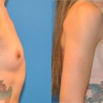 Breast Implant #31 - Before and After