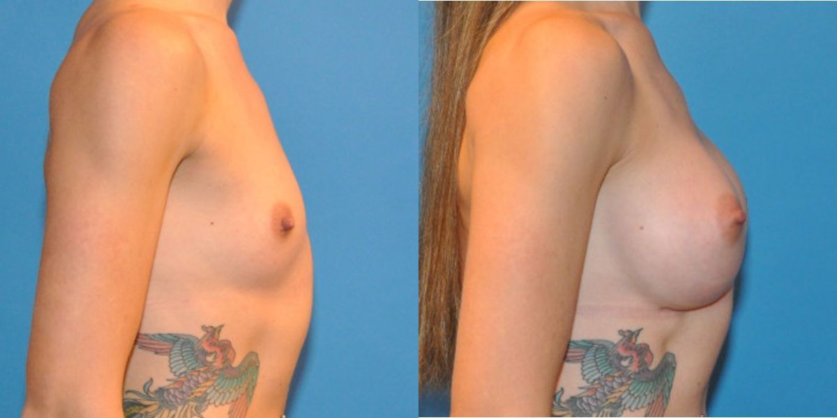 Breast Implant #31 - Before and After