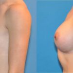 Breast Implant #31 - Before and After