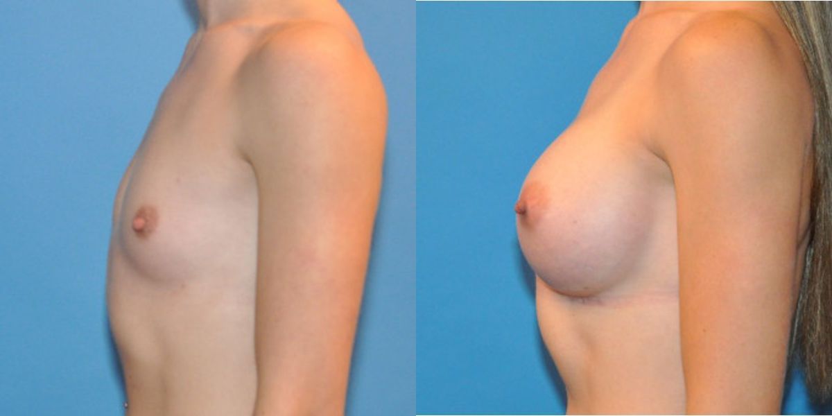 Breast Implant #31 - Before and After