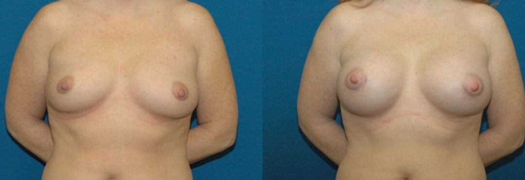 Breast Implant #32