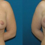 Breast Implant #32 - Before and After