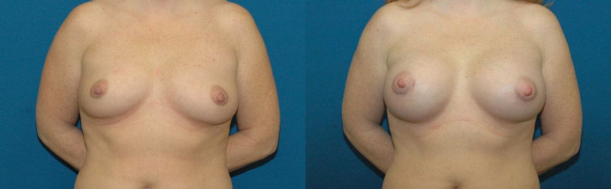 Breast Implant #32 - Before and After