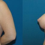 Breast Implant #32 - Before and After