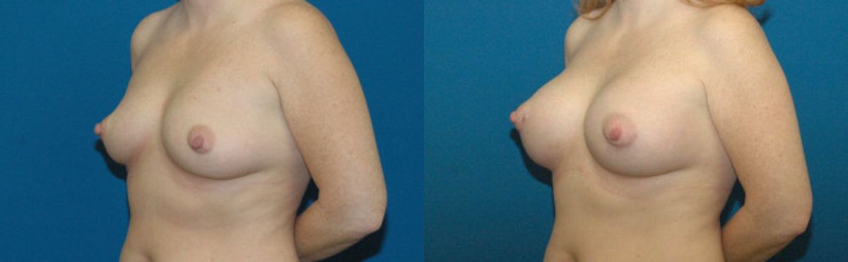 Breast Implant #32 - Before and After