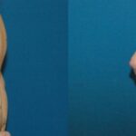 Breast Implant #32 - Before and After