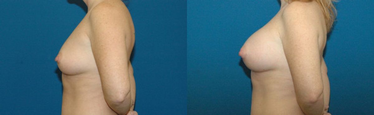Breast Implant #32 - Before and After