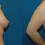 Breast Implant #32 - Before and After