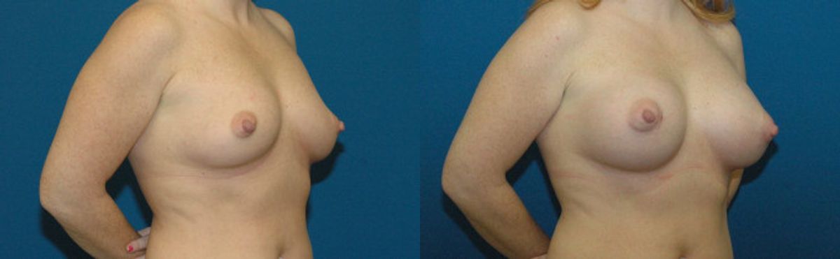 Breast Implant #32 - Before and After