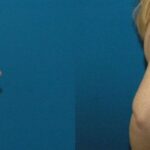 Breast Implant #32 - Before and After