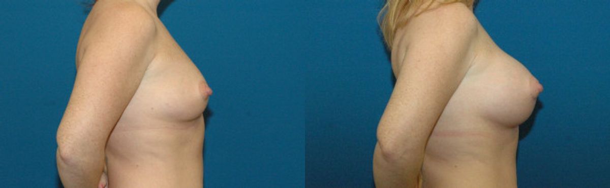 Breast Implant #32 - Before and After