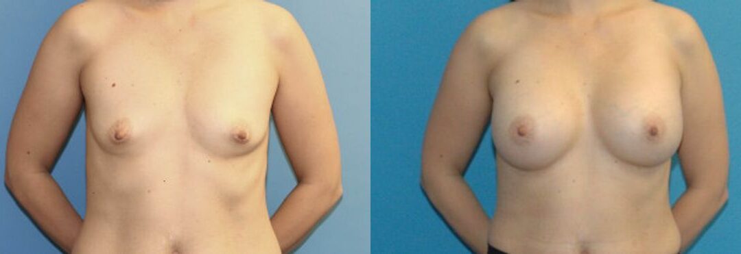 Breast Implant #33