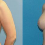 Breast Implant #33 - Before and After