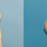 Breast Implant #33 - Before and After