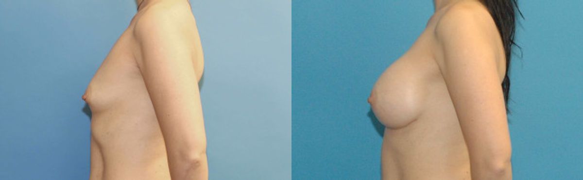 Breast Implant #33 - Before and After