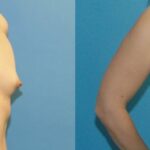 Breast Implant #33 - Before and After