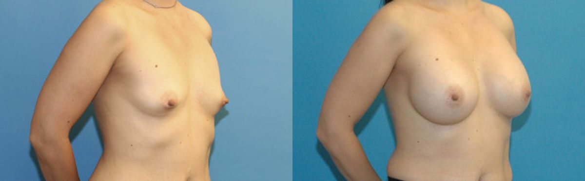 Breast Implant #33 - Before and After