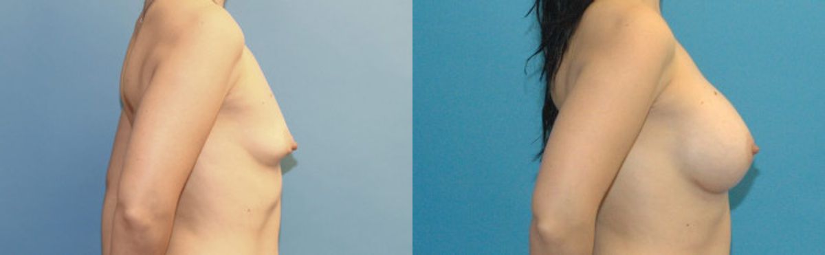 Breast Implant #33 - Before and After