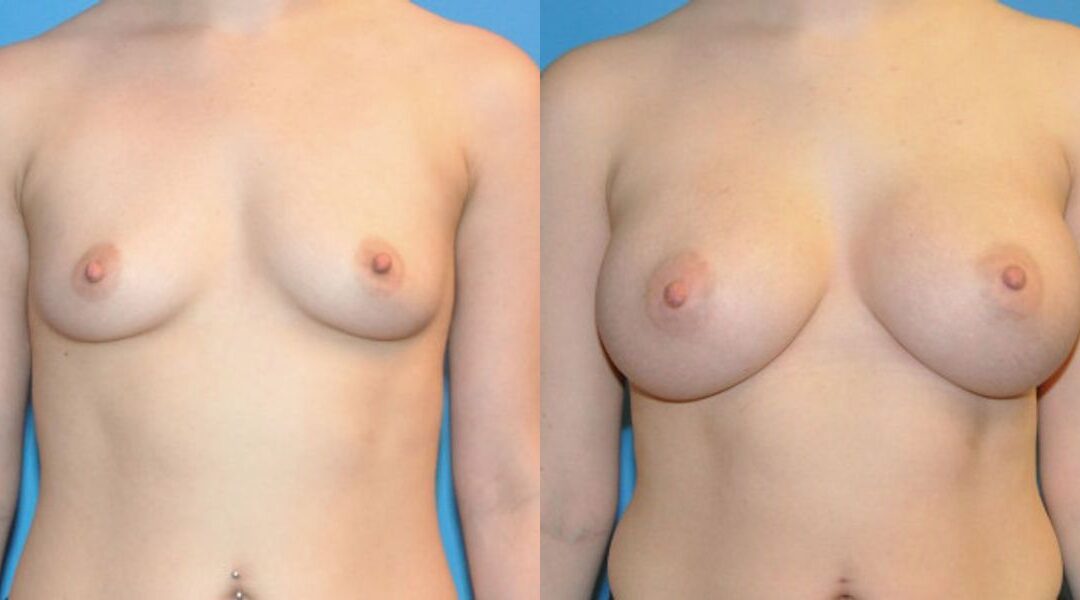 Breast Implant #34