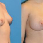 Breast Implant #34 - Before and After