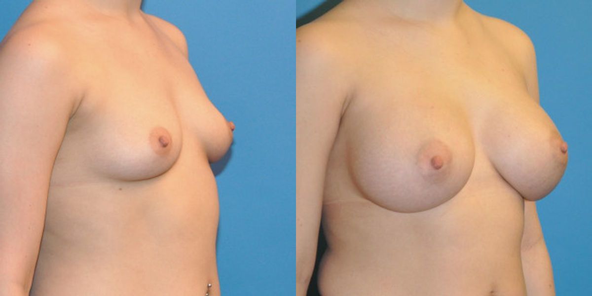 Breast Implant #34 - Before and After