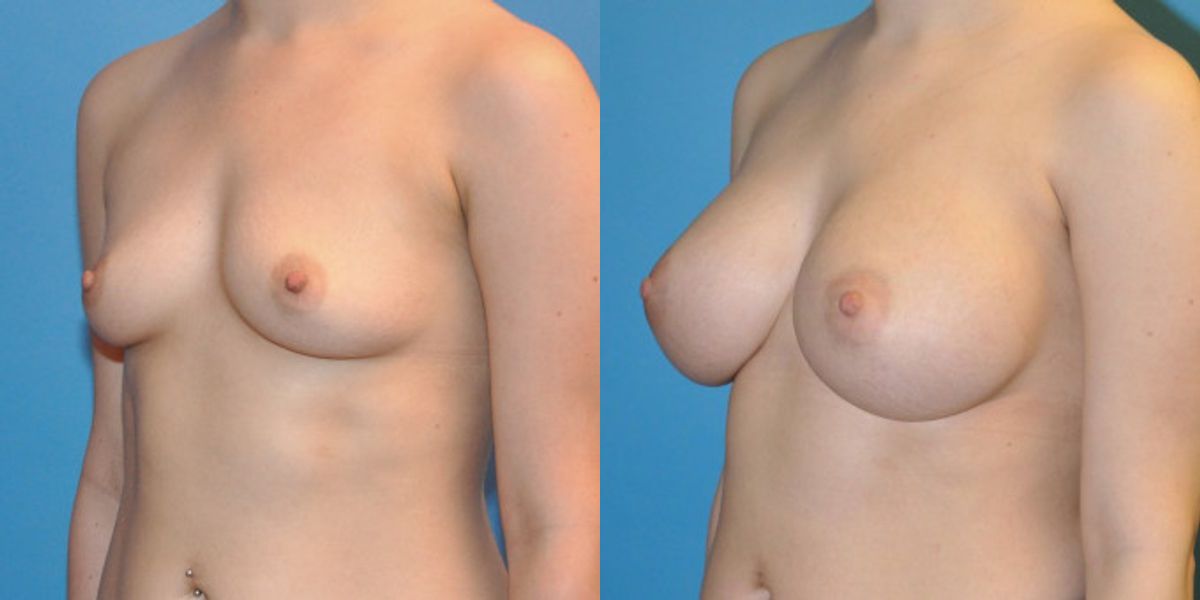 Breast Implant #34 - Before and After