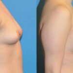 Breast Implant #34 - Before and After