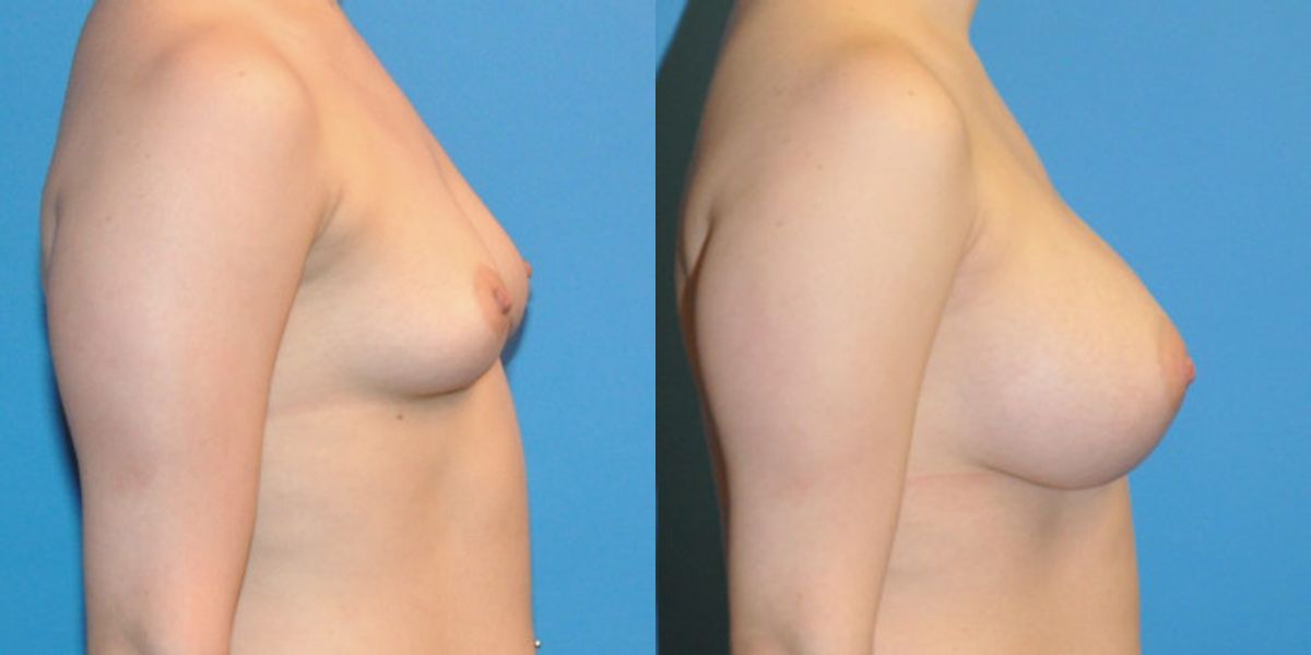 Breast Implant #34 - Before and After