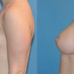 Breast Implant #34 - Before and After