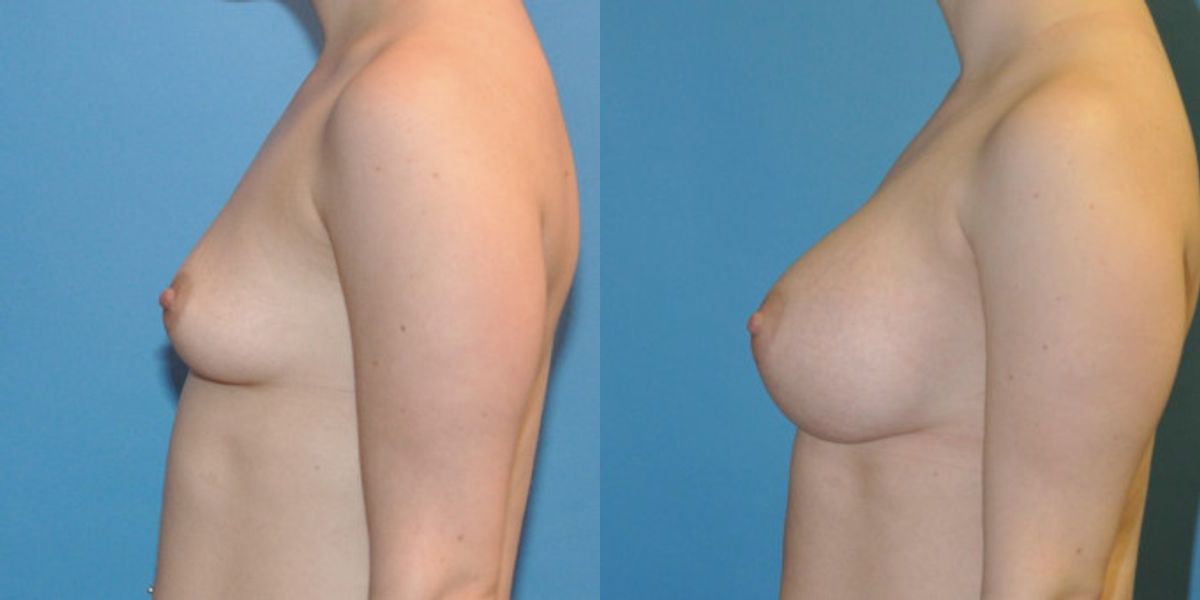 Breast Implant #34 - Before and After
