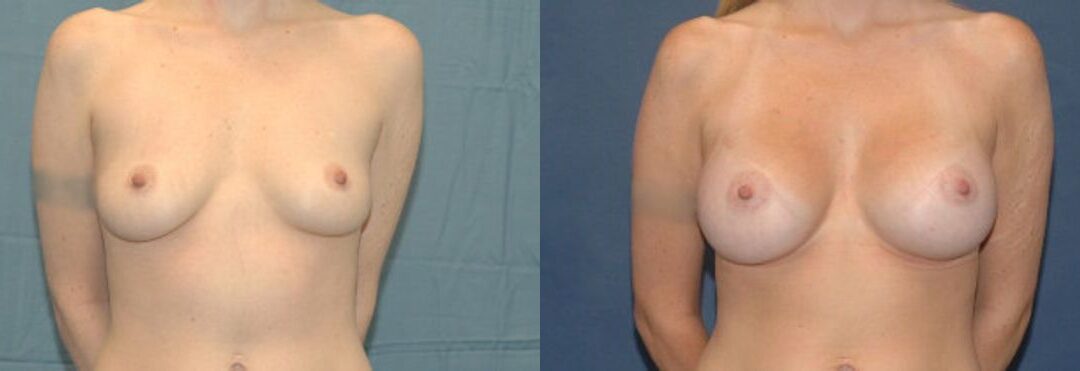 Breast Implant #35