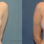 Breast Implant #35 - Before and After