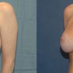 Breast Implant #35 - Before and After