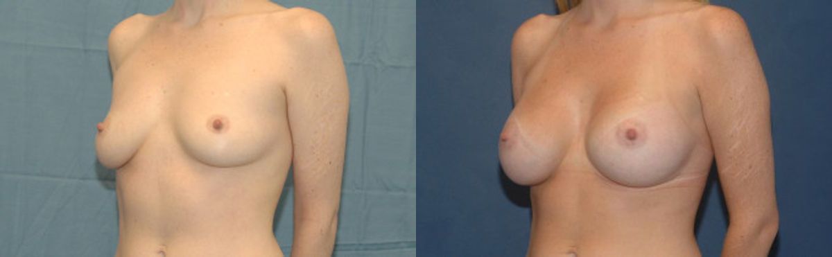 Breast Implant #35 - Before and After