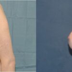 Breast Implant #35 - Before and After