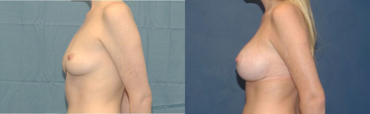 Breast Implant #35 - Before and After