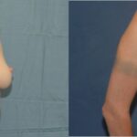 Breast Implant #35 - Before and After