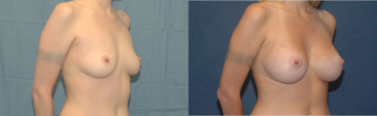 Breast Implant #35 - Before and After