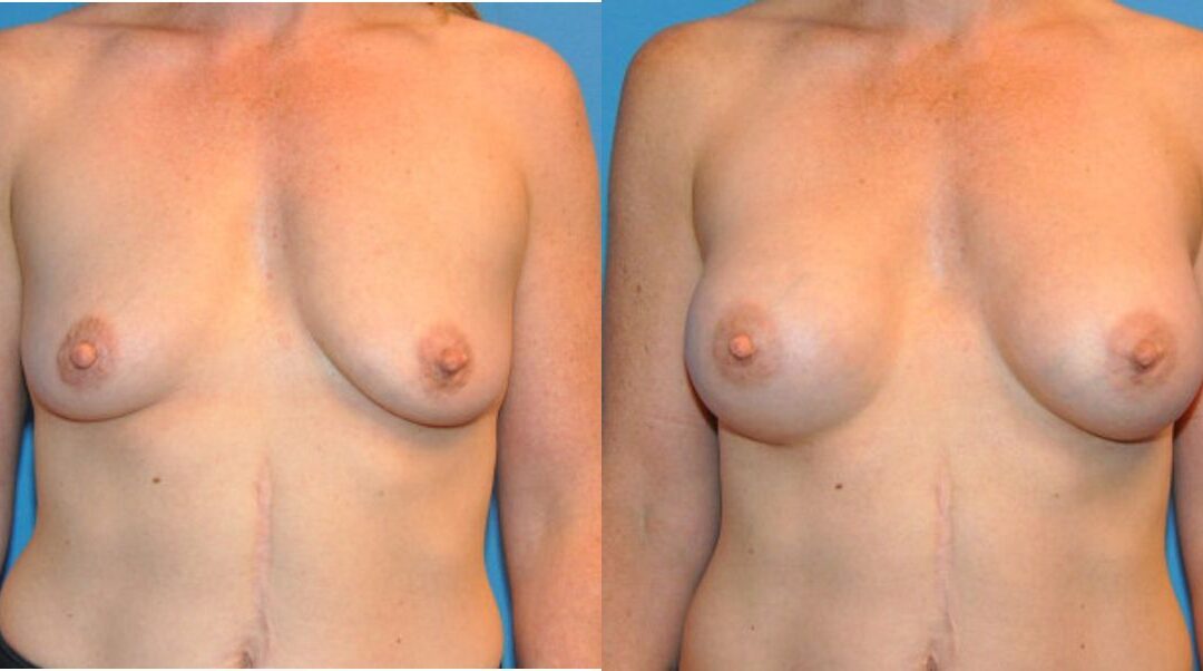 Breast Implant #36