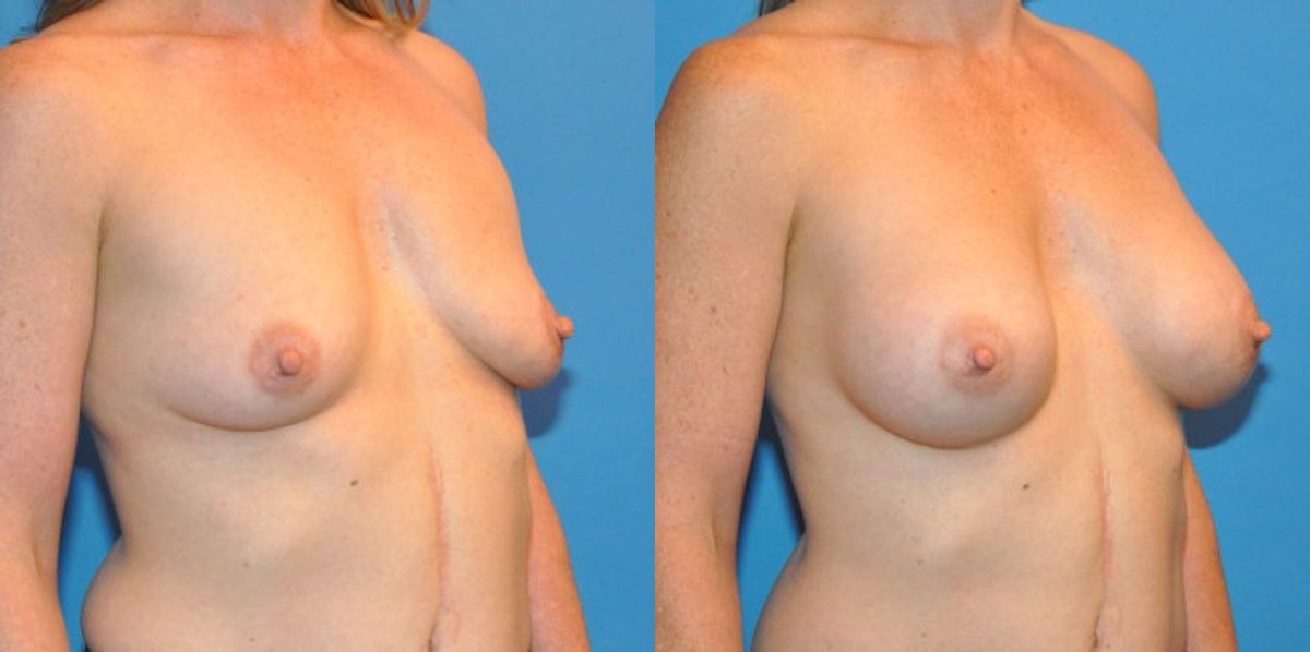 Breast Implant #36 - Before and After