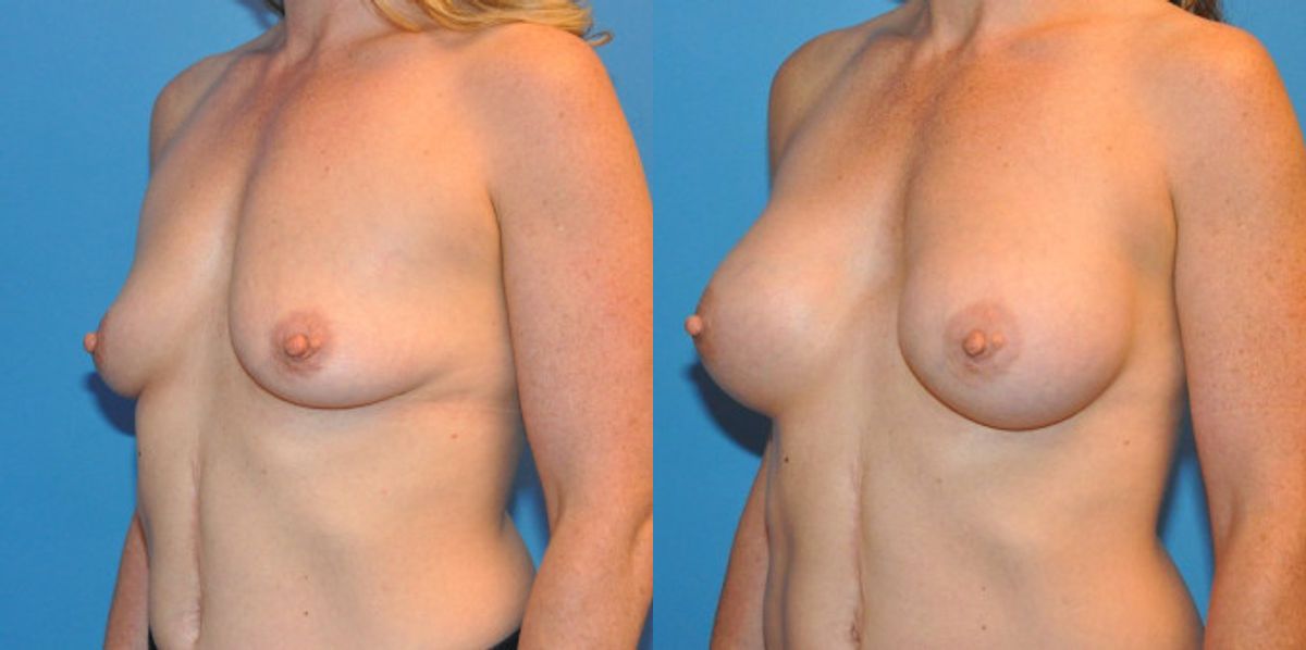 Breast Implant #36 - Before and After